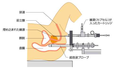 図2　永久挿入密封小線源療法